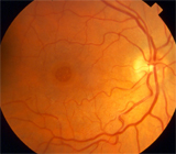 Macular Hole Treatment | Retinal Tear Treatment | Marion IL | Dexter MO