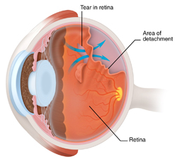Retinal Tear Treatment | Retinal Detachment Treatment | Marion IL | Dexter MO