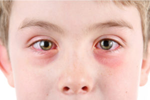 Boy with conjunctivitis